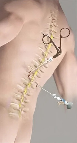 4 Key Facts to Help You Decide on Scoliosis Surgery with Confidence